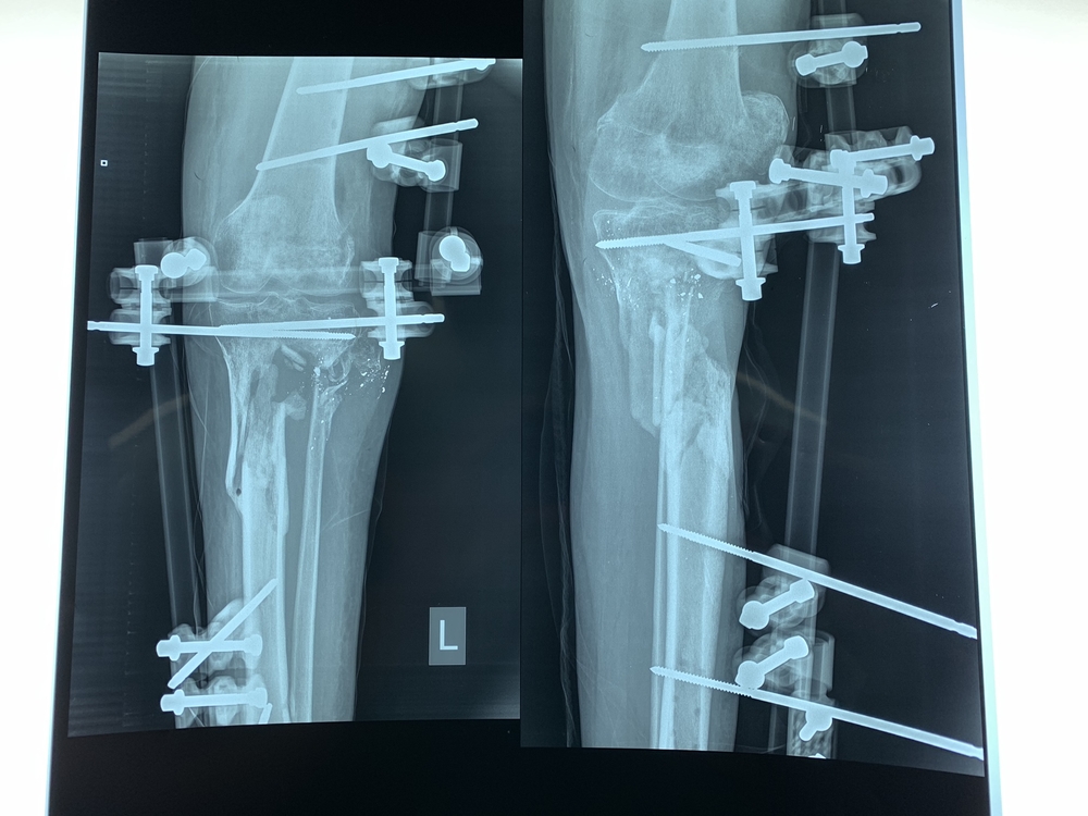 Surgeries in Al-Awda Hospital