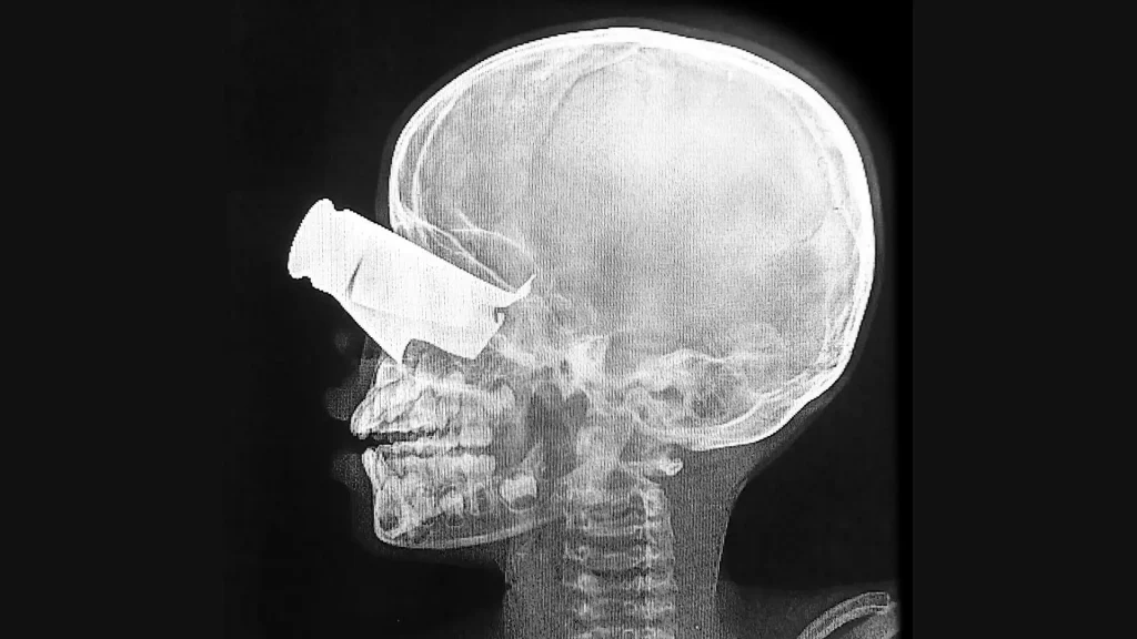 Un niño de nueve años llegó al hospital apoyado por MSF en Tine, Chad, en febrero, tras un ataque con drones en el oeste de Sudán. Presentaba una gran herida de metralla en el ojo, graves fracturas faciales y dos dedos amputados. Fue trasladado a Yamena para recibir tratamiento.