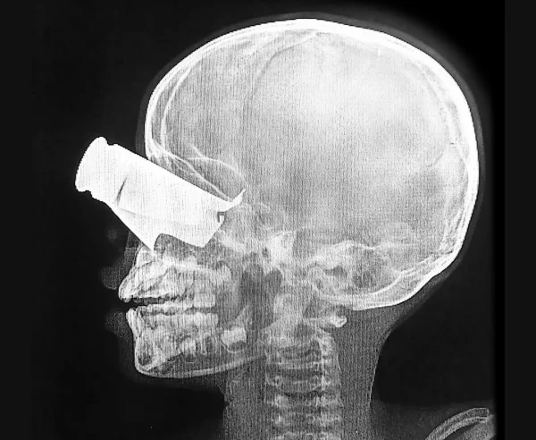 Un niño de nueve años llegó al hospital apoyado por MSF en Tine, Chad, en febrero, tras un ataque con drones en el oeste de Sudán. Presentaba una gran herida de metralla en el ojo, graves fracturas faciales y dos dedos amputados. Fue trasladado a Yamena para recibir tratamiento.