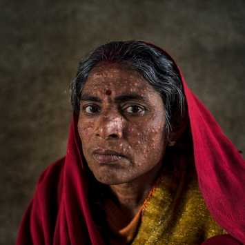 Kala Azar in Bihar