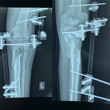 Surgeries in Al-Awda Hospital