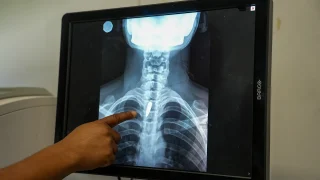 Una radiografía muestra una bala alojada en el pecho de Linda. Los cirujanos determinaron que era demasiado arriesgado extraerla, por lo que tendrá que seguir viviendo con ella. Linda fue alcanzada mientras estaba en la iglesia, cuando un grupo armado abrió fuego contra un helicóptero que se cree está vinculado a la policía. Puerto Príncipe, Haití, enero de 2026.