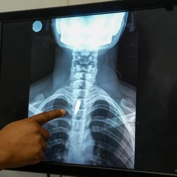 Una radiografía muestra una bala alojada en el pecho de Linda. Los cirujanos determinaron que era demasiado arriesgado extraerla, por lo que tendrá que seguir viviendo con ella. Linda fue alcanzada mientras estaba en la iglesia, cuando un grupo armado abrió fuego contra un helicóptero que se cree está vinculado a la policía. Puerto Príncipe, Haití, enero de 2026.