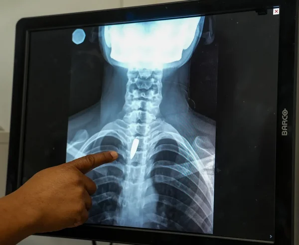 Una radiografía muestra una bala alojada en el pecho de Linda. Los cirujanos determinaron que era demasiado arriesgado extraerla, por lo que tendrá que seguir viviendo con ella. Linda fue alcanzada mientras estaba en la iglesia, cuando un grupo armado abrió fuego contra un helicóptero que se cree está vinculado a la policía. Puerto Príncipe, Haití, enero de 2026.